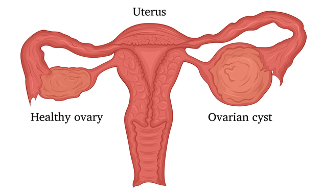 Ovarian-cysts-1