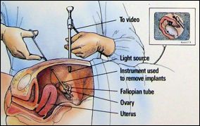 Shows-how-laparoscopy-is-done